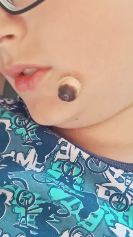 #asmrsounds #blackhead #pimple #fyp #doctor #infection #funny 