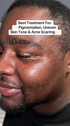 The easiest way to clear up pigmentation & scarring for the most glowiest, brightest & even skin 💕 #foryoupage #foryou #trending #skin #skincare #clearskin #acne #acneskin #hyperpigmentationtreatment #desi 