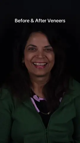 Veneers before and after #veneers #CapCut 