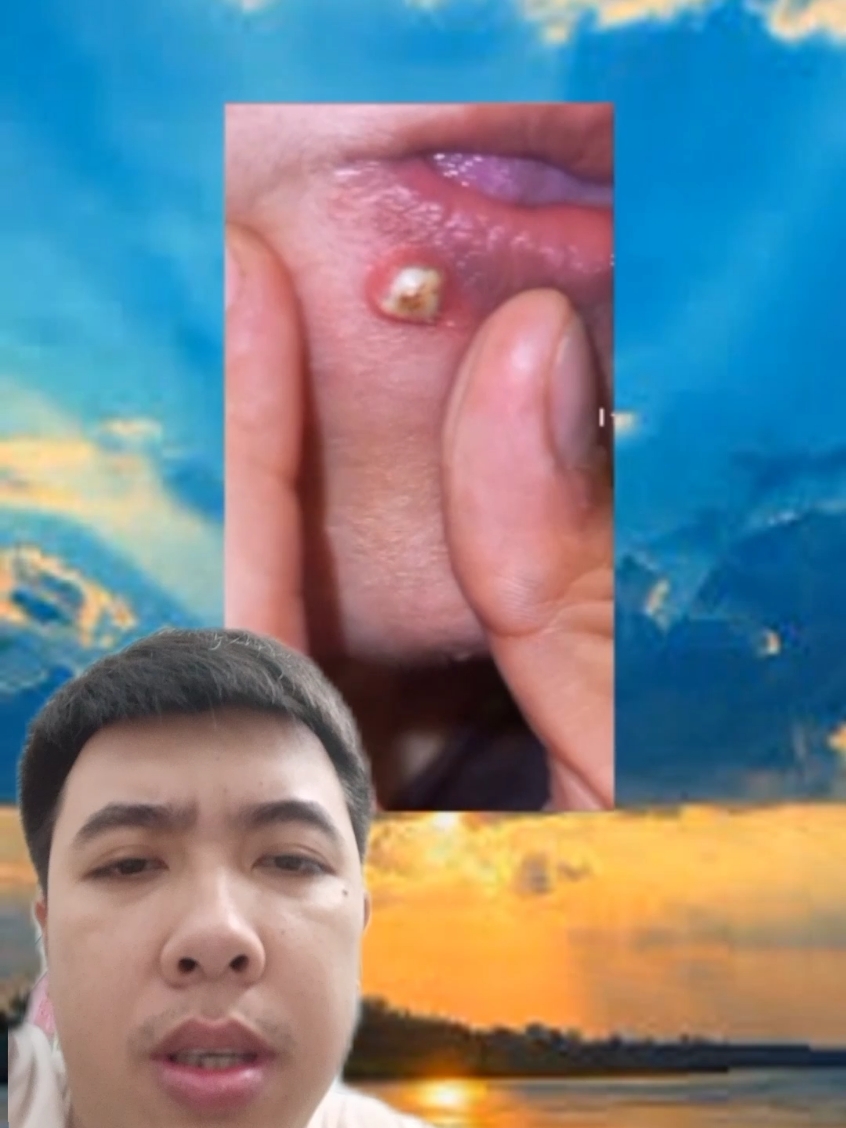 pimple acne skincare blackhead cyst popping satisfying video cleaning #pimple #acne #skincare #blackhead #cyst #popping #satisfying #satisfyingvideo #cleaning #CleanTok #satisfyingcleaning #fyp 