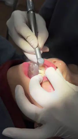 Mài răng cho e gái đến từ Hạ Long#xuhuong #răng_sứ_thẩm_mỹ 