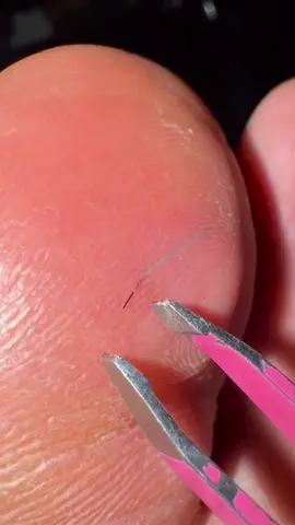 Had this ingrown hair in my toe last night #pimples #fy #fyp #pimple #satisfying #pop 