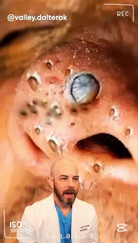 They're mashing on these blackheads!  #skincare #foryoupage #doctor #satisfying - #doctor #react #skincare #squeezeyuk #acne #pimple #pimplepop #blackhead #satisfying #foryoupage #foryou  #تنظيف_بشره  #whiteheads #رؤوس_سوداء #عنايه_بالبشره #دهون 