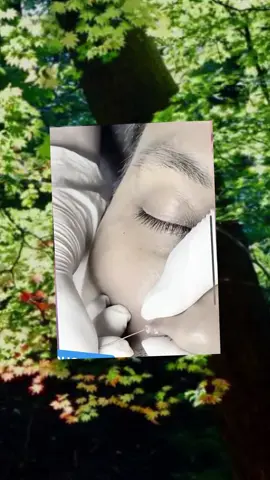 #squeeze #squeezeyuk #acne #pimple #pimplepop #blackhead #satisfyingvideos #fyp