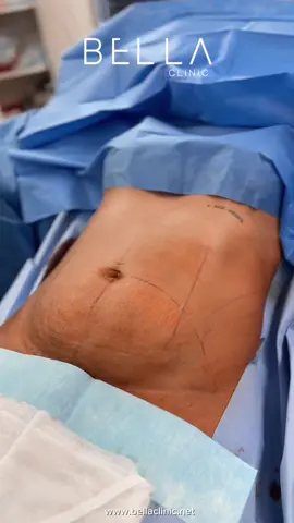 “A tummy tuck, or abdominoplasty, is a specialized surgical procedure designed to remove excess skin and fat while restoring abdominal contours. Tailored to individual needs, it offers both aesthetic and functional benefits. Contact us and make your consultation 😍 #bellaclinic #istanbul #turkey #surgery #viral #beauty #foryou #explorer #tummytucksurgery 