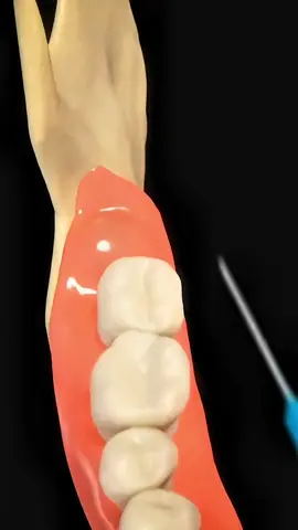 Wisdom tooth removal  #3dmedicalanimation #wisdom #wisdomteeth #wisdomsociety #wisdomteethaftermath #wisdomtoothsurgery #surgeryofwisdom #surgery #surgeryoftooth #surgeryodteeth 