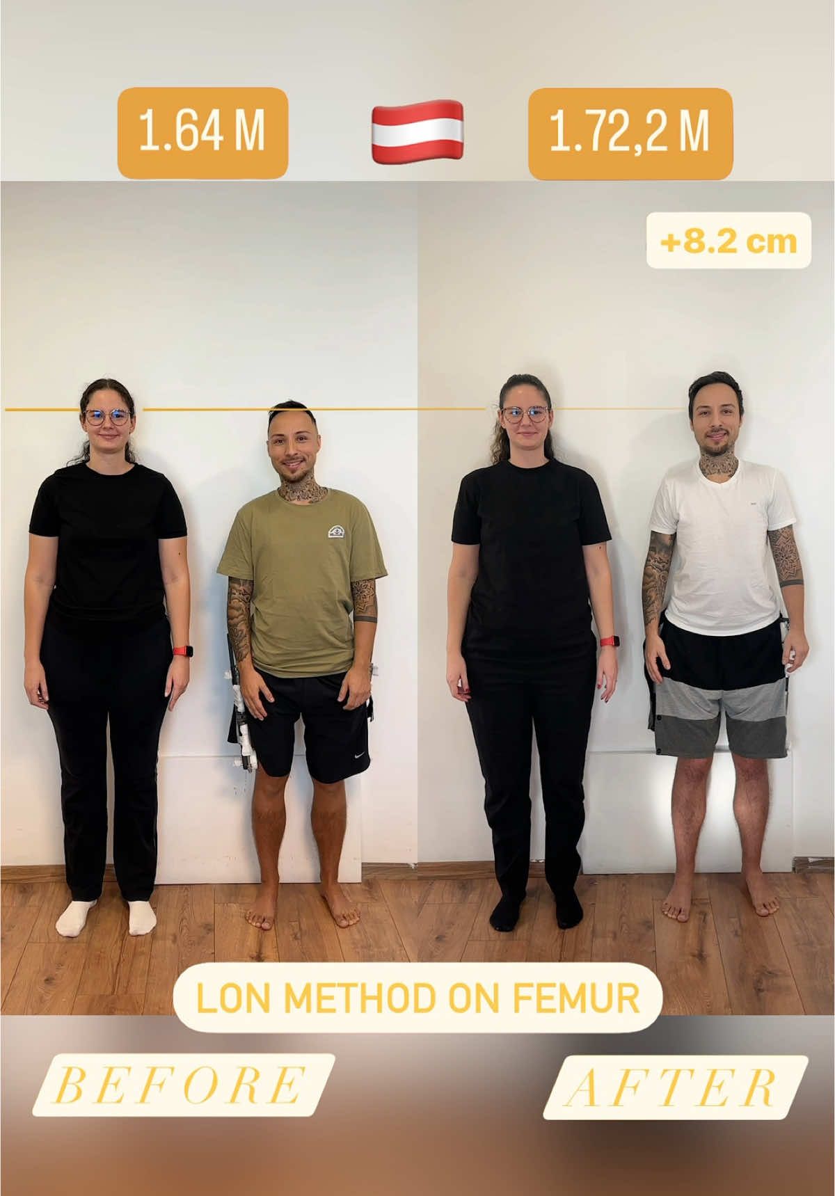 The place where the dreams come true... #limblengthening #dreamscometrue #transformation #beforeandafter  1.64 m ➡️ 1.72,2 m 🇦🇹 #transformation #changeyourlife #heightsurgery