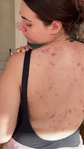 It is the mites in the body that are multiplying#acne #bodywash #bodycare #body #fyp #skin #quarxery #mite #mites #foryou #bacne