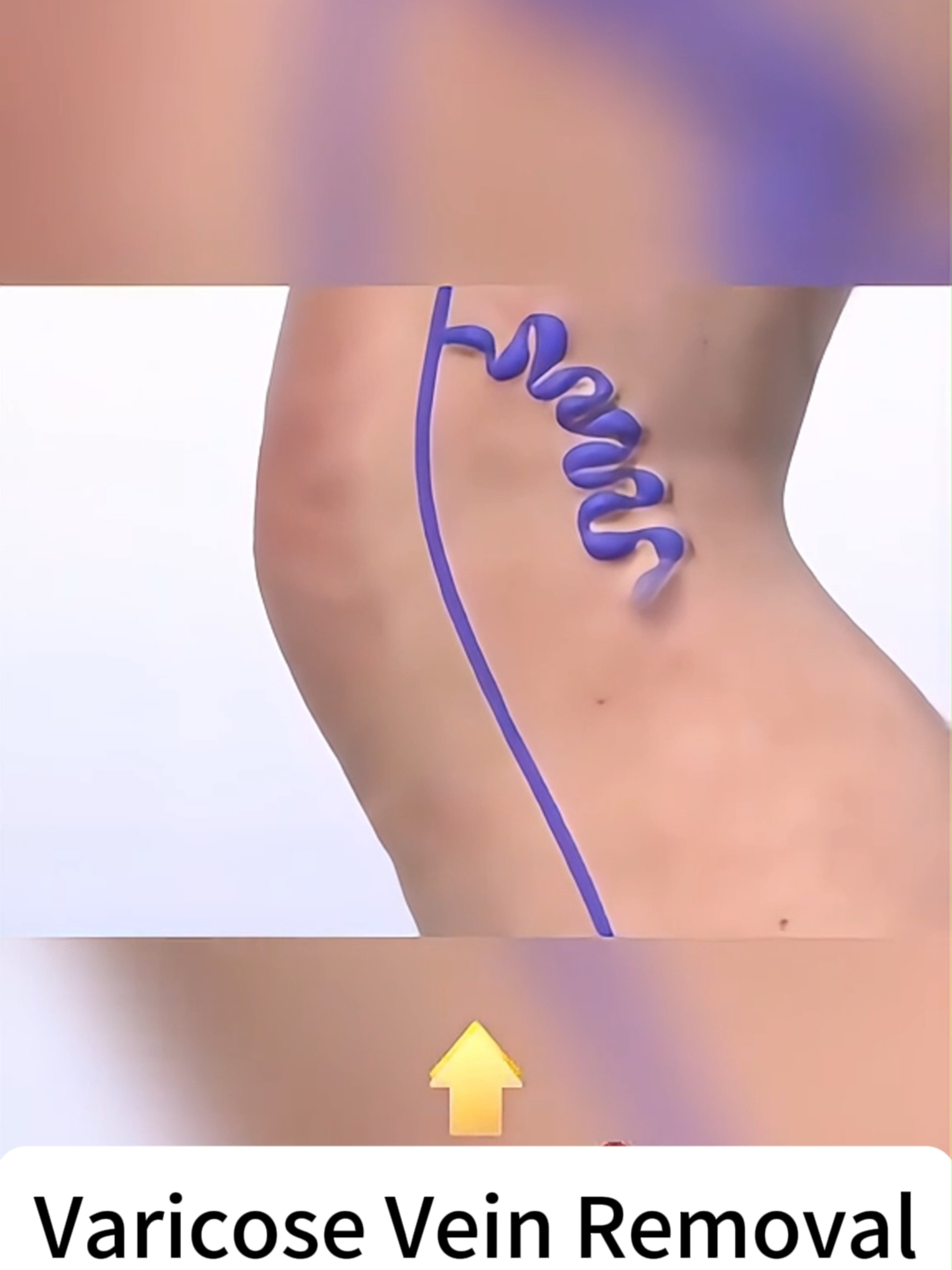 Long-term use can remove varicose veins✌️✌️ It's no joke🤡#paineelief #Vascular #varicoseveinsremoval #Varicoseveins #varicoseveinstreatment #spiderveinsolution #Spiderveins #tiktokshop #fypシ