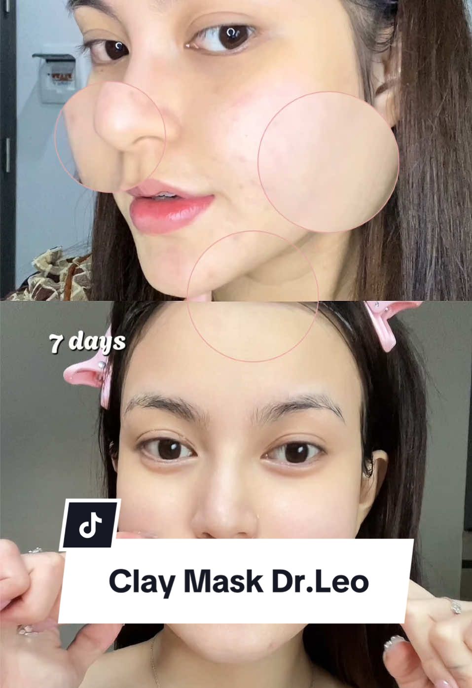 Dịu da với giảm mụn thiệc lunnnnn #drleo #poresvacuumcleaner #claymask  #skincare #skincareroutine #fyp #goclamdep #LearnOnTikTok   #xuhuong 