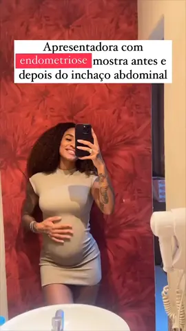 Apresentadora com endometriose mostra  inchaço abdominal E esse antes e depois da Patrícia Ramos (@patriciaramos)? Não gente, ela não estava grávida! Isso é uma ENDOBARRIGA! Patrícia contou que sofreu com esse inchado após sair da dieta e comer lactose, glúten e açúcar. E ela mesmo contou em seu post: “Quando você tem endometriose e só sente o cheiro de glúten/lactose/açúcar. É dormir com a barriga inchada e acordar com ela chapada. Minha médica me alertou e eu só acreditei na prática. A DIETA é o fator principal do TRATAMENTO da doença”. Por isso falo tanto sobre o tratamento integrativo como uma ferramenta indispensável para tratar a endometriose. #endometriose #inchaçoabdominal #tratamentoendometriose O que é endobarriga e como ela se relaciona com a endometriose? A alimentação pode agravar os sintomas da endometriose? Quais alimentos causam inchaço abdominal em mulheres com endometriose? Como a dieta pode influenciar o tratamento da endometriose? É possível reduzir o inchaço abdominal com mudanças alimentares? O que acontece no corpo da mulher com endometriose quando ela consome glúten, lactose ou açúcar? Como a endometriose afeta a digestão e o sistema gastrointestinal? Existe uma dieta específica para mulheres com endometriose? O que a Patrícia Ramos compartilhou sobre sua experiência com a dieta e a endometriose? Como a inflamação relacionada à endometriose impacta o inchaço abdominal? Quais são os melhores alimentos para combater o inchaço em mulheres com endometriose? Dietas sem glúten e sem lactose podem ajudar a controlar a endometriose? Como a endometriose afeta o metabolismo e a absorção de nutrientes? Quais são os tratamentos complementares à dieta para controlar os sintomas da endometriose? A dieta pode substituir o uso de medicamentos no tratamento da endometriose?
