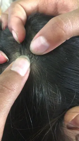 #ticks #omg #ticksremoval #song #live #fouryou #fyp #tiktokindia #LearnOnTikTok 