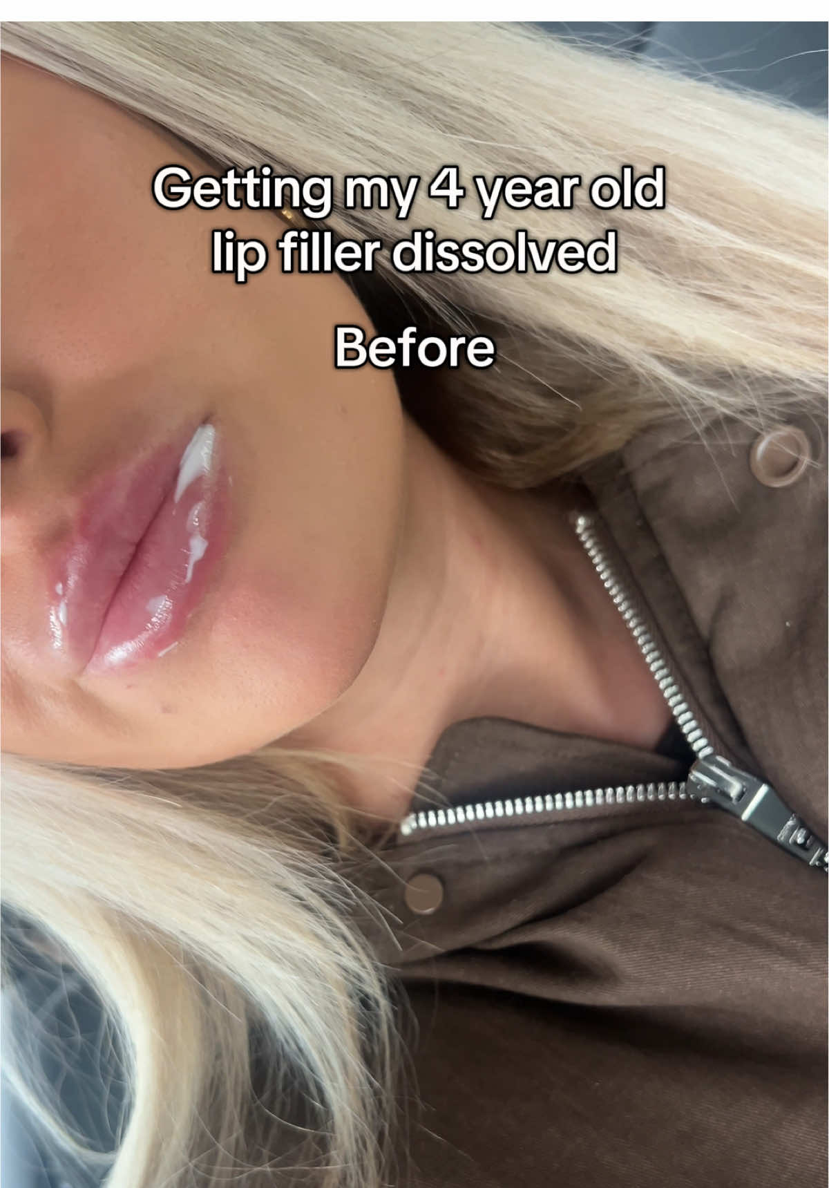 excited to get them refilled Saturday but a refresh was needed🤗🤗🤗 #fyp #fup #foryoupage #fupシ #fypツ #lipfiller 