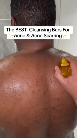 The best cleansing bars that clears acne, acne scarring, pigmentation & uneven skin on face and body!✨💥  #foryoupage #foryou #trending #skin #skincare #clearskin #acne #acneskin #hyperpigmentationtreatment #desi