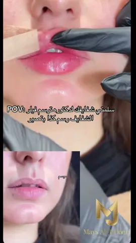 #تجميل #فيلر_شفايف #فيلر #فلر #قبل_وبعد #foryou #foryoupage #fypシ #عيادات_تجميل 
