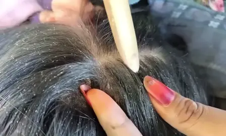 #lice #😱😱😱😱😱😱😱😱😱😱 #liceremoval #popping #kutu #2025 