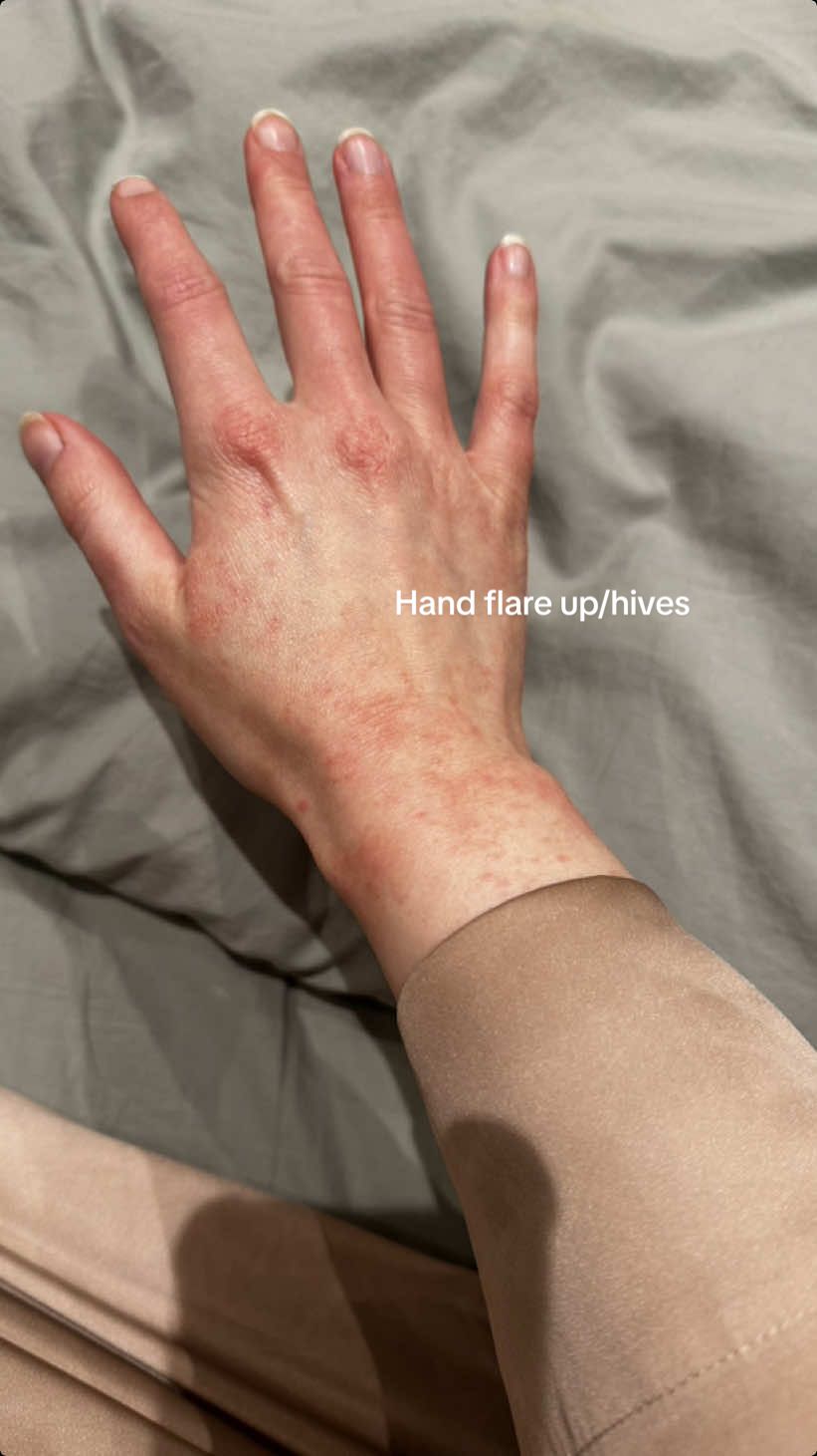 When the hand flare/hives come out of no where?! Not been in contact with anything I feel would set me off.. am I allergic to life ??? (This is a very mild flare up but my hands have been doing okay for a while, not reacting like this, so very annoying!) #eczema #eczemaawareness #dermatitis #eczematiktok #eczematiktok #eczemacommunity #atopicdermatits #tsw