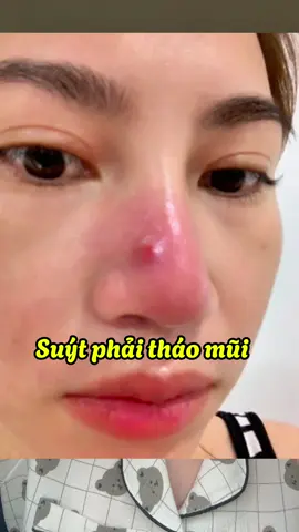 Kẻ thì của mụn viêm- mụn mủ- mụn thâm đây rồi. #chammun #chammundrleo #drleo