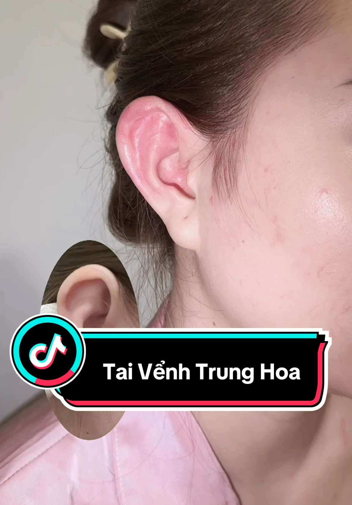 Tiêm filler tai vểnh xong  K.H iêu nói ưng vá nên thôi không đi độn tai vểnh nữa ạ 🤤 #tiemtaivenh #taivenhtrunghoa #bienhinh #filler #fillerbotox #lamdepuytin #hcm #amienguyenbeauty #botox #tiemtaitailoc #tiemtratrunghoa #lamdepuytin 
