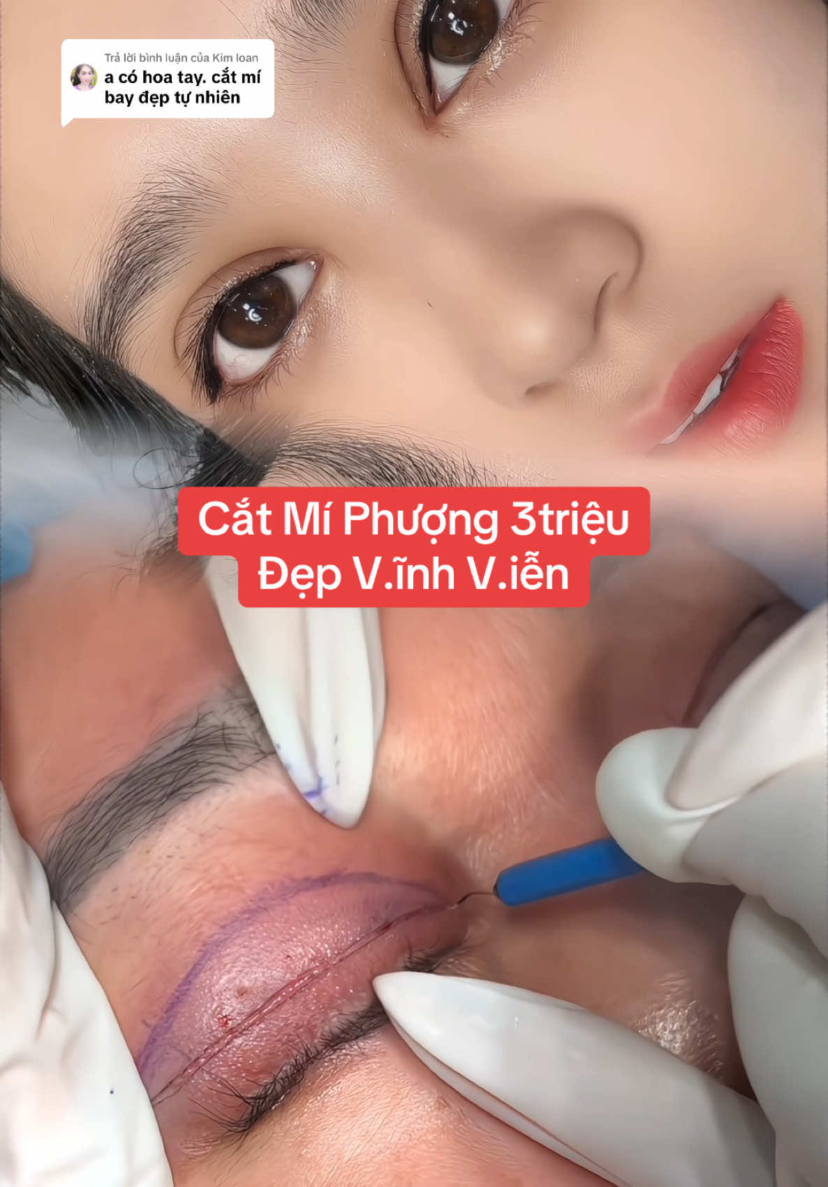 Trả lời @Kim loan Nếp Mí Tròn Đều 3tr ! #catmi #catmiphuong #mogocmat #catmitunhien #pttm #bacsikim 