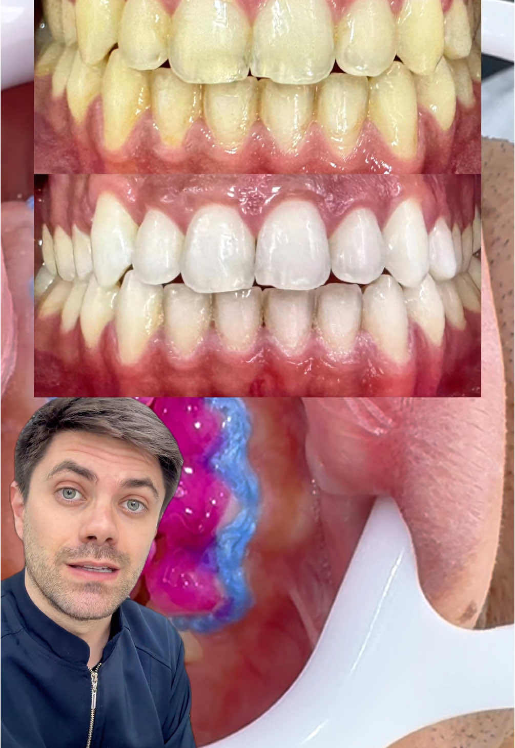 Clareamento de consultório #clareamentodental #dentista 