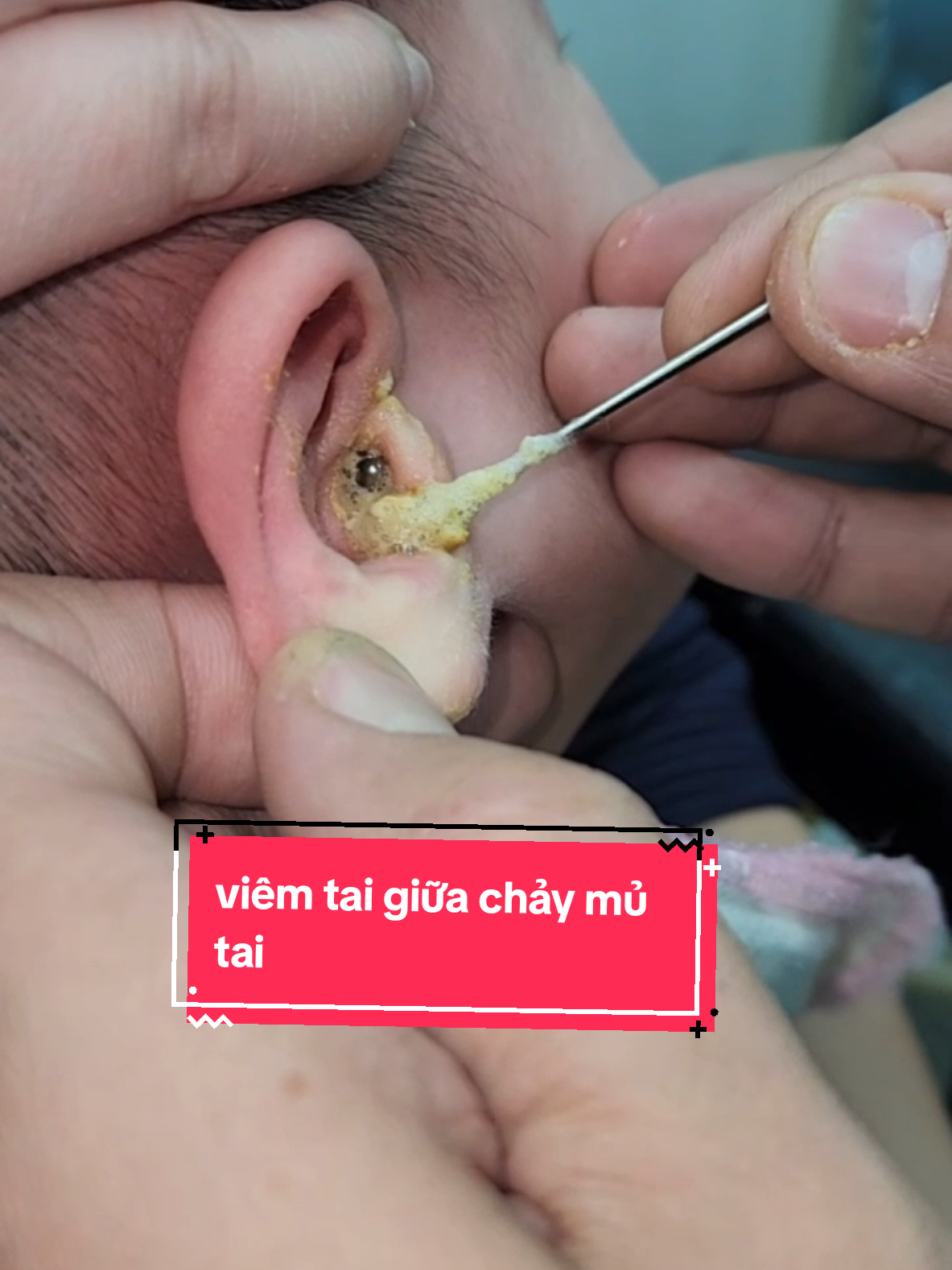 thương em lắm, nhưng trộm vía hôm nay sau 3 ngày điều trị tai bé đã khô rồi! #bacsidungtran #viemtaigiua #mayhutmui 