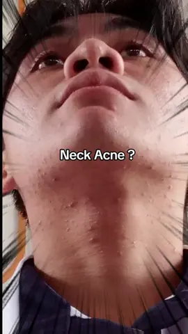 If you are also troubled by back acne, then you should try this body wash#acne #bodywash #bodycare #body #fyp #skin #quarxery #mite #mites #foryou