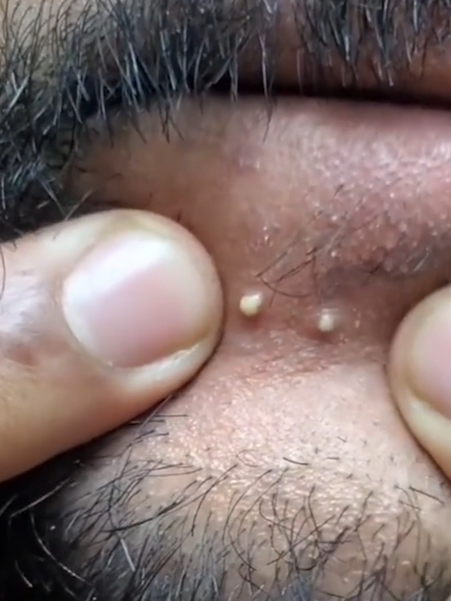 A squeeze for the win #blackheads #extractions #pimplepop