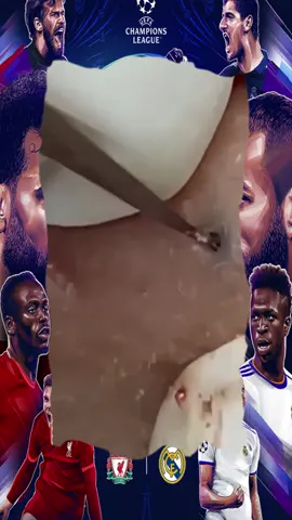 #pimpleparadise90 #blackheads #oddlysatisfying #satisfyingvideo #relaxing #pimplepop