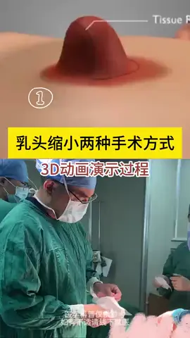 乳头缩小3D动画演示 #乳头缩小手术 #假体隆胸 #乳房下垂缩小手术
