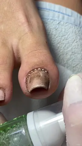 Antes e depois 🦶 Produtos usados foram da loja @Dani Loja 🚨 Comprando Dani Loja tem desconto com CUPOM: Carla 🥰🫶🏻 #unhasdospes #unhasdasemana #asmrvideo #asmrnails