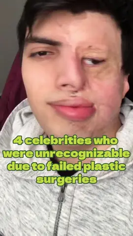 4 Celebrities Who Were Unrecognizable Due to Failed Plastic Surgeries #usa#us#celebrity#hollywood#celebrities#famous#fyp 