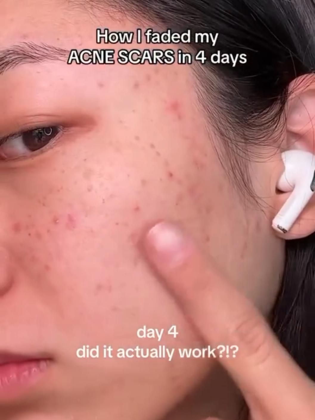 anua niacinamide 10% + txa 4% dark spot correcting serum 30ml #instagram #Love #memes #instagood #follow #fyp #trending #viral #foryou #video #viralvideos #comedy #foryoupage #funnyvideos #musically #videos #foryourpage  #tiktokmemes  #tiktokdance #prank #tiktokindo #viraltiktok #tiktokchallenge #tiktokhot #homeforlife #roza #tahsan 