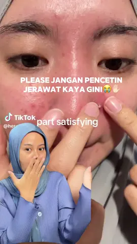 ‼️disclaimer hasil bisa berbeda disetiap orang‼️ tp di aku oke 👍 #acnetreatment #fyp #acne #fyp #drleo #drleoID #acnebuster #acnesolution #pimple #skincare 