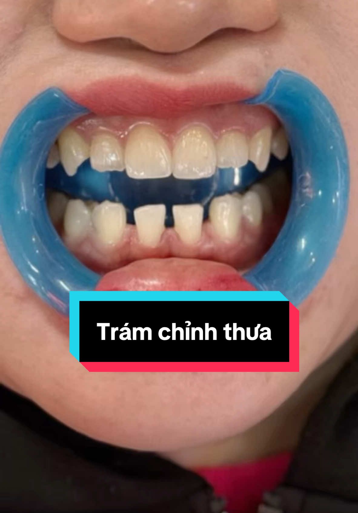 Trám chỉnh thưa hàm dưới 🦷#trám_răng_thưa #trámrăng_sứt_mẻ #trám_răng_sâu #xuhuong #yfp #tiktokviral #làm_đẹp #hottrend 