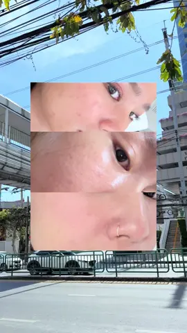 พังได้ก็ปังได้เหมือนกัน ขอให้กำลังใจคนที่เป็นสิวและทิ้งหลุมทิ้งรอย @BkkBeautyClub #bkkbeautyclub  #ความสวยบอกต่อ