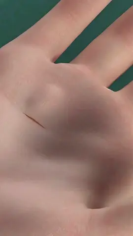 Trigger finger surgery #medicalhumor #wristsurgery #triggered #triggerfinger #triggerfingerchallenge #triggerfingerrelease #triggerfingerinjection #triggerfingersurgery #triggersurgery #dingersurgery #surgeryoffinger 