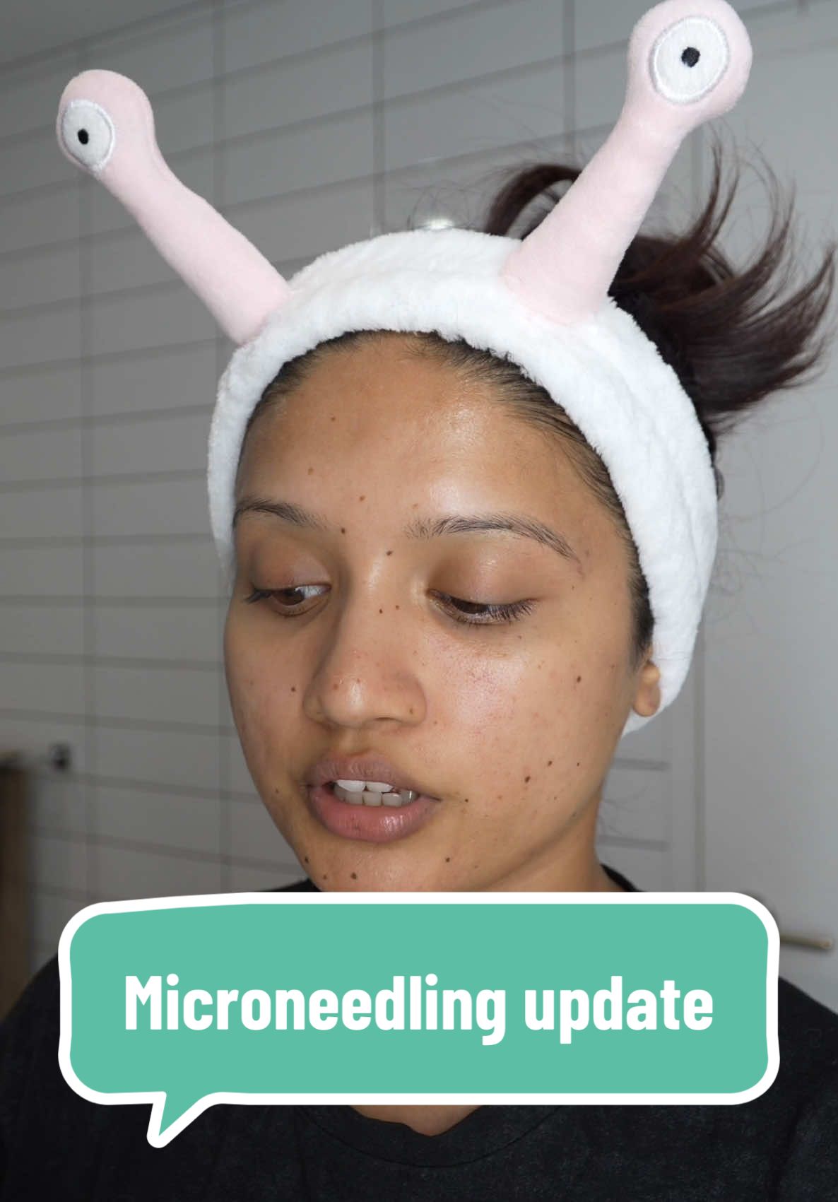 Microneedling update! My skin is currently in the peeling phase, but it feels like it’s glowing more than it did yesterday😊✌️ Products use: @anua_us oil cleanser and hyaluronic gentle foaming cleanser  Quia collagen overnight mask  #microneedling #nightskincare #skincareroutine #acneproneskin 