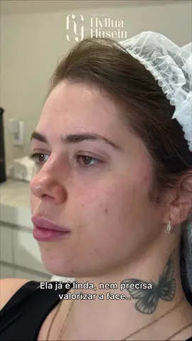 Precisava?  #harmonizacaofacial #hof #harmony #preenchimentodelabios #preenchimentofacial 