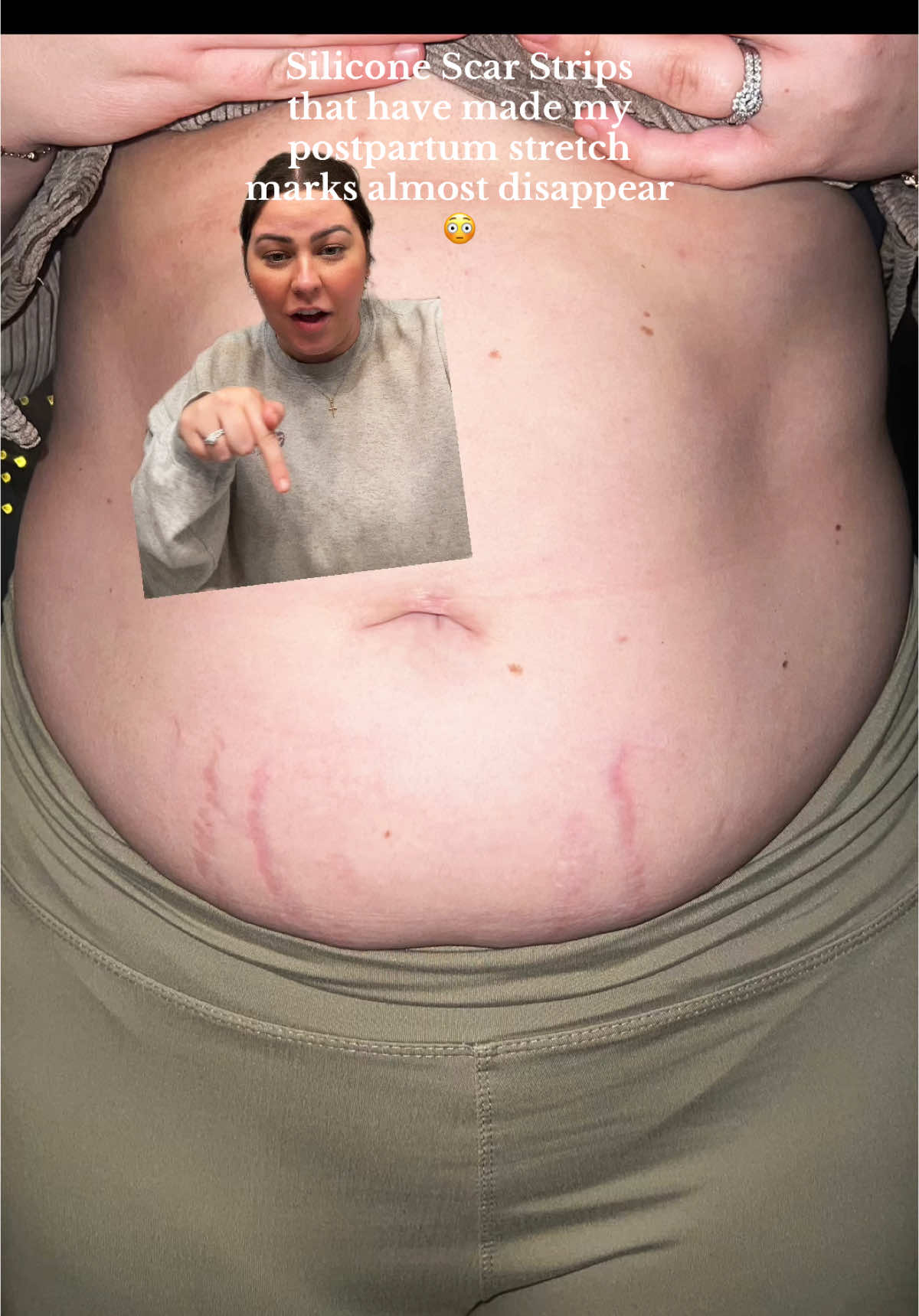 This would also do amazing for any C-section scarring ☺️ ##postpartum##postpartumbody##postpartumrecovery##postpartumjourney##postpartumweightloss##postpartumlife##postpartumweightlossjourney##stretchmarks##stretchmarksolution##csectionrecovery##csectionscar##pregnant##pregnantbelly##mom##MomsofTikTok##momlife##momtok##momhack##mommusthaves##momcontent##momcontentcreator##mombod##mombody##beautyhacks