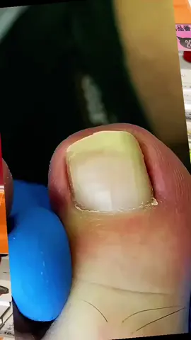 #ingrowntoenailremoval #tiktokchallenge #foryou #viralvideo #thisis4u #ingrowntoenail #nails #toenails #pedicure