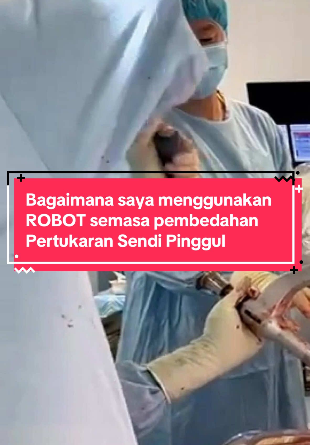 Video kali ni saya nak terangkan bagaimana saya menggunakan Robotic Assistance semasa pembedahan Pertukaran Sendi Pinggul / Total Hip Replacement dan kenapa penggunaan teknologi robot kini sangat membantu. Kalau ada apa2 soalan tentang pembedahan lutut atau pinggul, boleh PM saya. WhatsApp untuk buat appointment 👉🏼 www.wasap.my/60164201585/HelloDrJR #DrJR #pakarortopedik #pakarortopedikanda #orthopedics #lutut #knee #surgery #totalhipreplacement #kneesurgery #ankleinjury #bukulali #kneesurgeryrecovery