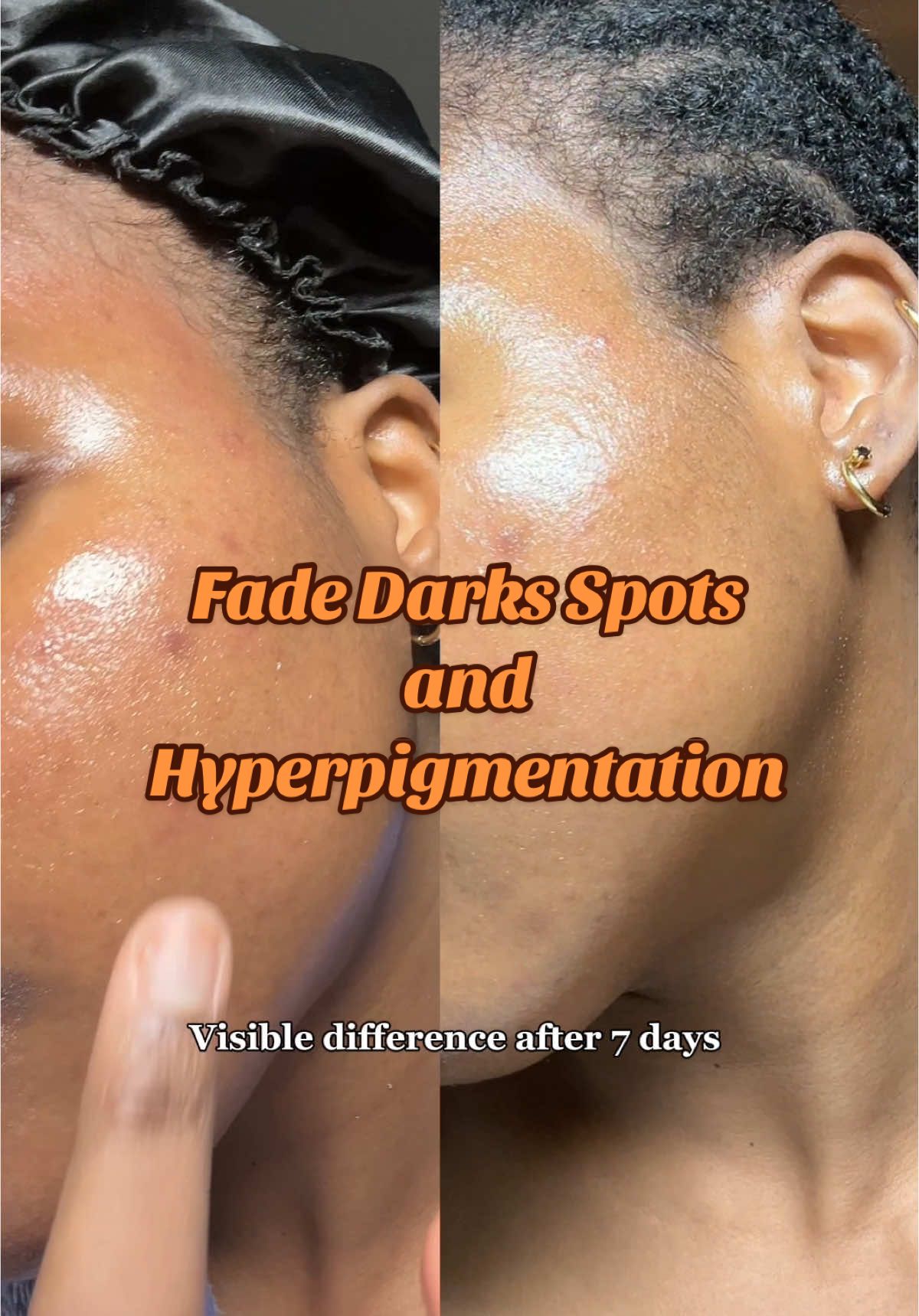 Hopped on the skin1004 Tone Brigtening Capsule Ampoule and this is my result after 7 days❤️❤️ #skincare #darkspots #darkspottreatment #darkspotserum #hyperpigmentation #skin1004 #darkspoteraser #spoteraser #discoloration #centellaasiatica #centella #kbeauty #skintips #glassskin #glowyskin #koreanskincare #acnescars #tonebrightening #blemishes #pigmentation  @SKIN1004 Official 