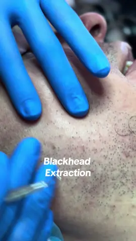Satisfying Blackhead Extraction! 🧖‍♂️✨ Extractions are included with any facial—but did you know you can also book an appointment just for extractions? If you’re struggling with stubborn blackheads or breakouts, leave it to the pros! ❌ Avoid picking at your skin at home—improper extraction can lead to scarring and irritation. ✅ Our experts use professional techniques to safely remove congestion and keep your skin glowing. 📅 Book your appointment today and let’s clear those pores! (Link in bio)  #BlackheadExtraction #ClearSkin #Dermatology #BermanSkinInstitute #Skincare #pimple #extraction #pimplepopper #male #medical #dermatology #aesthetic #esthetician #estheticianlife #clinic #bayarea #losaltos #paloalto #satisfying 