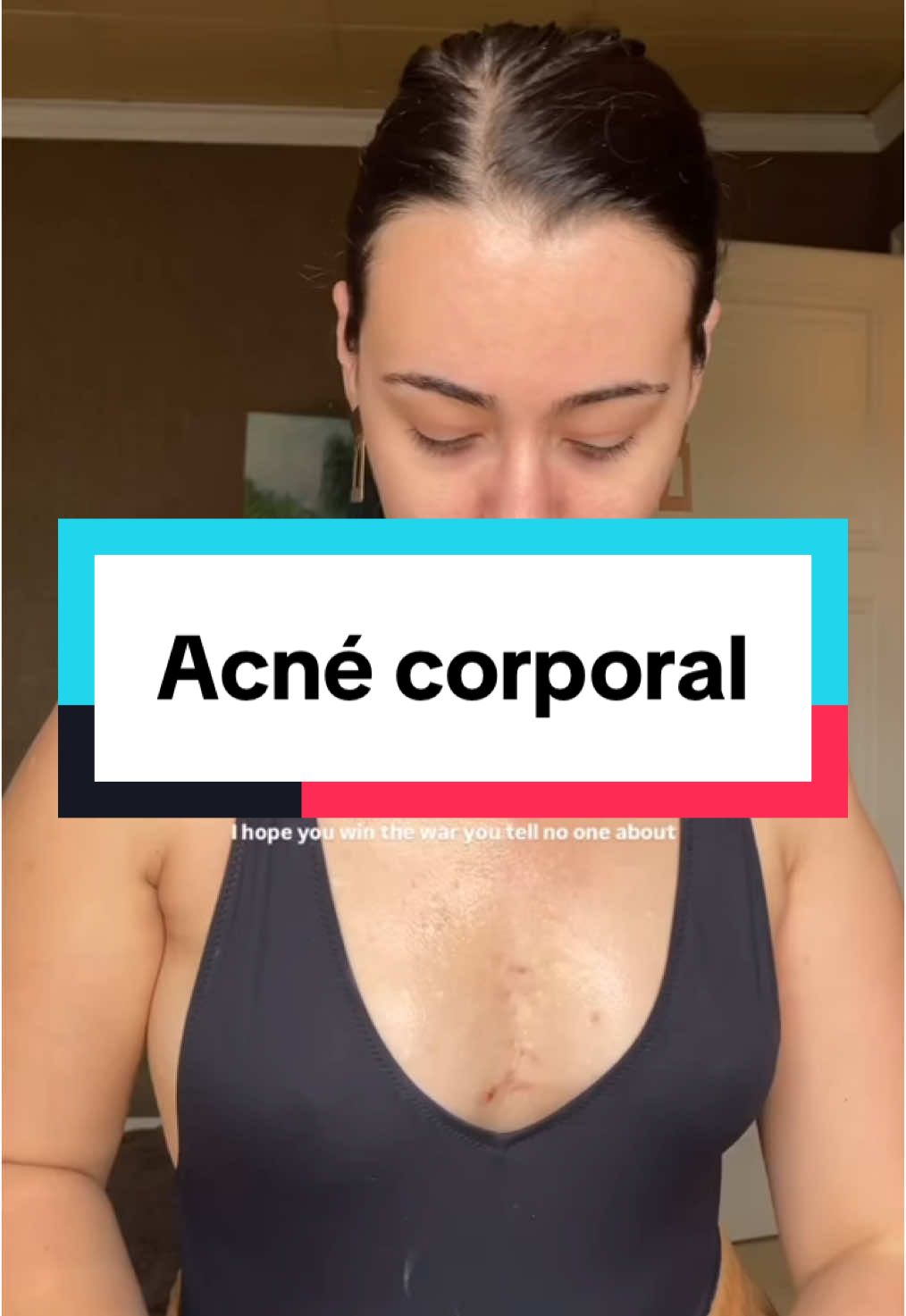 Un breve resumen del tratamiento de acné corporal, no te olvides de consultar siempre con tu derma. . 👉🏻consultas virtuales a todo el 🌎 . Presenciales en Valencia 🇪🇸 . . . #drapascali #acnécorporal #bacne #acnéenlaespalda 
