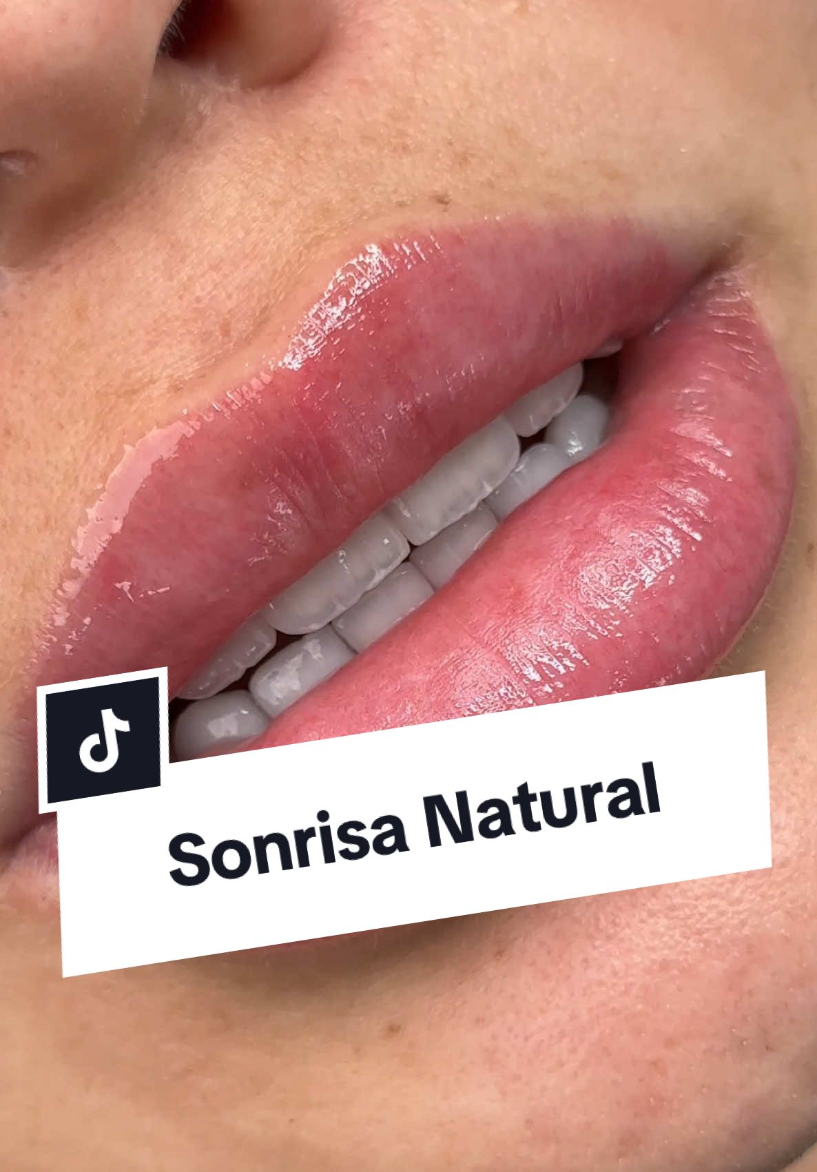 Ｌｅｎｔｅｓ  Ｃｅｒａ́ｍｉｃｏｓ💎 Natural smile design Son delgadas capas de disilicato dé litio (E.max) con maquillaje en cerámica, que se adhieren a la cara frontal del diente. Son realizados a medida y personalizado para cada paciente, imitando la naturalidad, forma, textura, color, brillo y translucidez del diente.  La mejor alternativa para cambiar tu sonrisa, respetando la biología, la salud y mejorando la estética 💎👌🏽 #diseñodesonrisa #diseñodesonrisacolombia #lentesceramicos #veneers #porcelainveneers #diseñodesonrisabogota #diseñodesonrisaibague #sonrisanatural #carillasdentales 