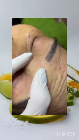 #fyppppppppppppppppppppppp #fyp #skincare #relaxing #relaxingvideos #pimple #whiteheads 
