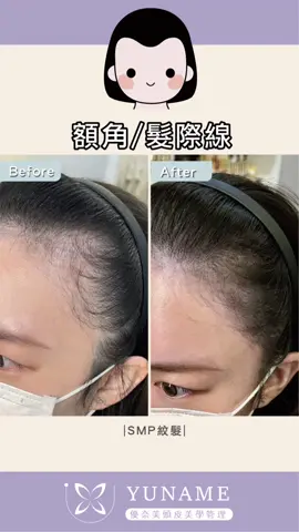 SMP紋髮-髮際線/額角 最近的客人都是之前有紋過髮 其實這比還沒有紋過的難度是更高一點 因為要想辦法修飾原本的缺點是要一些技術的 但是我還是克服了這些困難 讓客人滿意的離開工作室了🙂 歡迎各位來讓我接受挑戰😁 有興趣了解更多 歡迎 賴 線上預約諮詢：@575oitoh https://lin.ee/w6psDhv #紋髮 #smp #科技育髮教學 #外泌體育髮 #生髮 #落髮 #禿頭 #偽毛囊  #紋髮際線 #分線填補 #髮際線 #yuname優奈美頭皮美學管理  #新北育髮 #三重紋髮 #蘆洲紋髮 #新北紋髮 #三重育髮 #蘆洲育髮 #台北市紋髮 #台北市育髮 #メディカル #エクソソーム育毛 #脱毛 #在台日本人 #台湾メディカルヘルスケア #台湾育毛