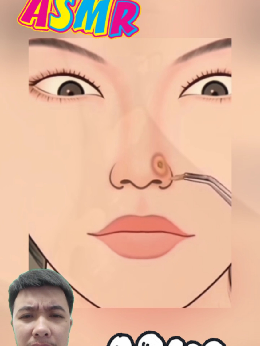 asmr #asmr #pimple #acne #blackhead 