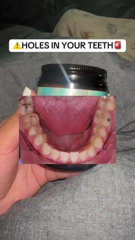 Cavities CAN heal with these tablets! #nobs #cavity #oralhealth #oralhygiene #oralcare